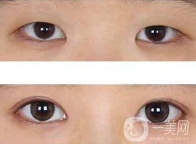 開眼角術后要眼角增生自己會消失嗎