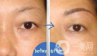 提切眉*果怎么樣？提切眉手術(shù)后注意事項(xiàng)