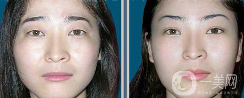 提切眉*果怎么樣？提切眉手術(shù)后注意事項(xiàng)