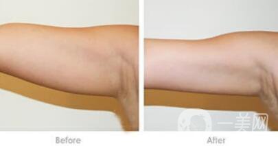吸脂瘦手臂*果怎么樣？輕松擁有纖細(xì)手臂