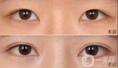 雙眼皮術后一個月能恢復自然嗎