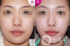 雙下巴怎么減才快速*？去雙下巴方法介紹