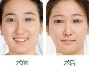 雙下巴怎么減才快速*？去雙下巴方法介紹