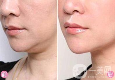 雙下巴吸脂術(shù)前準(zhǔn)備需要做哪些？
