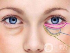 內(nèi)切祛眼袋多久恢復(fù)？