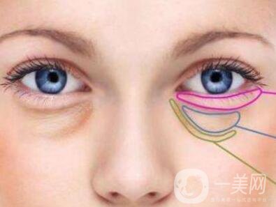 內(nèi)切祛眼袋多久恢復(fù)？