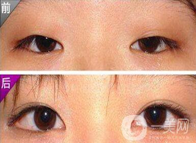 開外眼角風(fēng)險大嗎？