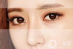 做韓式*雙眼皮術(shù)優(yōu)點有哪些