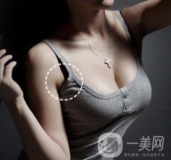 副乳切除術(shù)創(chuàng)口多大？