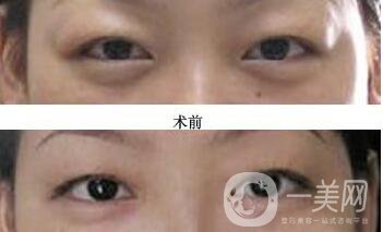 上眼瞼去脂,術(shù)后護(hù)理