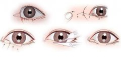 開內眼角要多久恢復 恢復期長短和哪些因素有關