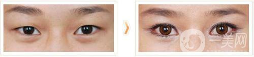 開內(nèi)眼角要多久恢復(fù) 恢復(fù)期長短和哪些因素有關(guān)