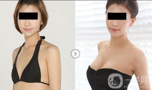 假體隆胸手術(shù)做完之后恢復期要多久時間？