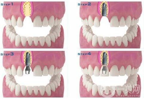 種植牙可以用多久 維持時(shí)間解析