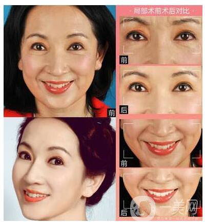 在淄博做瑞蘭注射除皺需要多少錢