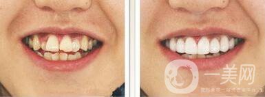 成都種植牙信息介紹？種植牙醫(yī)院信息介紹？