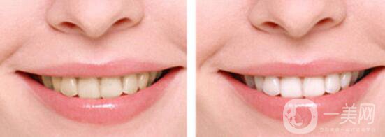 成都做*潔牙大概多少錢