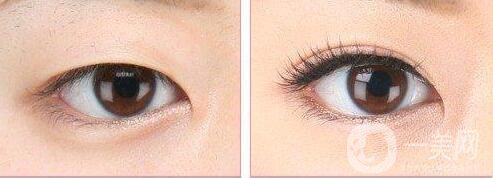 北京,割雙眼皮,醫(yī)院