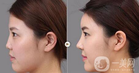 膨體隆鼻缺點(diǎn)主要有哪些？危害大嗎？