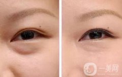 超聲波去眼袋好嗎，有哪些優(yōu)點(diǎn)？