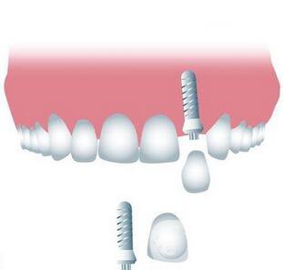 上海九院做一次種植牙價格是多少？價格貴嗎？ 