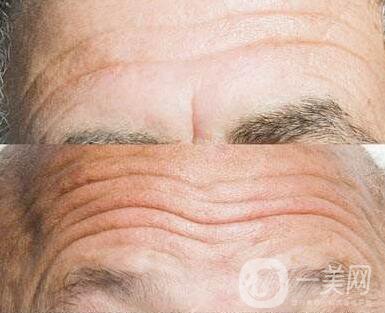 抬頭紋太重怎么辦？怎么消除抬頭紋？