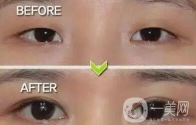 開(kāi)眼角,多少錢(qián),注意事項(xiàng)