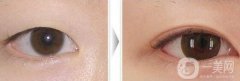 開(kāi)眼角手術(shù)前后，術(shù)后果杠杠的！
