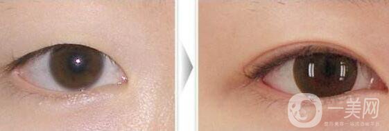 開眼角手術(shù)前后，術(shù)后*果杠杠的！