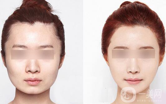 咬肌發(fā)達(dá)怎么辦？怎么處理？