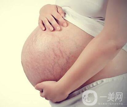 有妊娠紋怎么辦？什么方法**？
