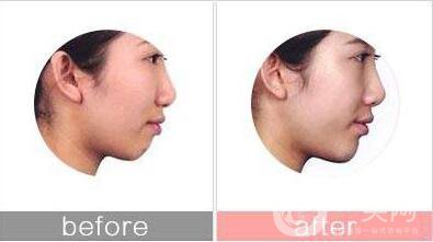 硅膠隆下巴,后遺癥