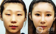 眼部抽脂前后，果明X看過(guò)來(lái)！