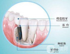 人工種植牙的價格要多少錢？