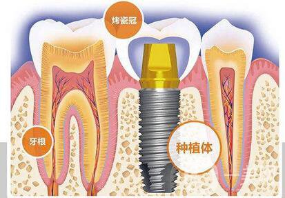 人工種植牙的價(jià)格要多少錢？
