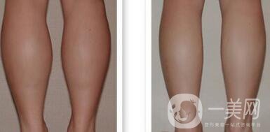 小腿吸脂能瘦幾厘米 輕松擁有纖細(xì)雙腿