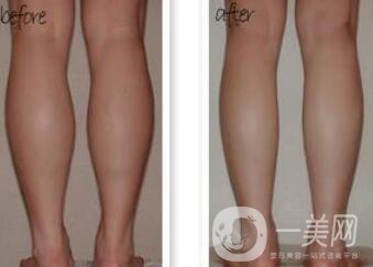 小腿吸脂能瘦幾厘米 輕松擁有纖細(xì)雙腿