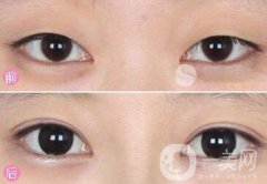 眼部手術(shù)都包含哪些項目？眼部手術(shù)整形多少錢