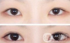 哪些人不適合做雙眼皮手術(shù)
