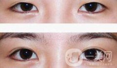 埋線雙眼皮多久消腫？幾天可以恢復(fù)自然