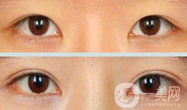 埋線雙眼皮多久消腫？幾天可以恢復(fù)自然