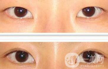 埋線雙眼皮多久消腫？幾天可以恢復(fù)自然