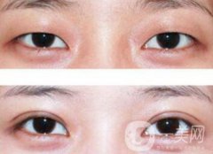 納米*雙眼皮術(shù)后注意事項有哪些