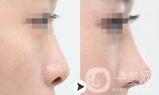 鼻小柱延長手術(shù)一般都用什么材料