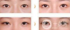 全切雙眼皮術(shù)后吃什么？術(shù)后如何護(hù)理