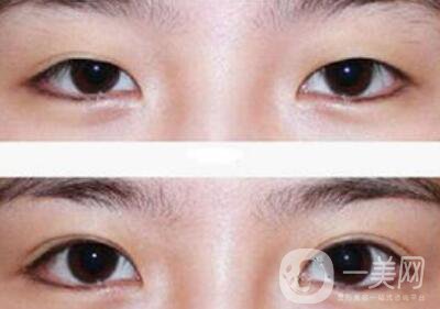 全切雙眼皮術(shù)后吃什么？術(shù)后如何護(hù)理