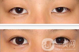 全切雙眼皮術(shù)后怎么護理？需要注意什么