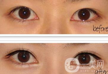 全切雙眼皮術(shù)后怎么護理？需要注意什么