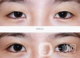 全切雙眼皮術(shù)后怎么護理？需要注意什么