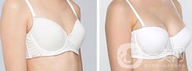 隆胸手術(shù)后多久恢復(fù)？術(shù)后注意事項(xiàng)有哪些